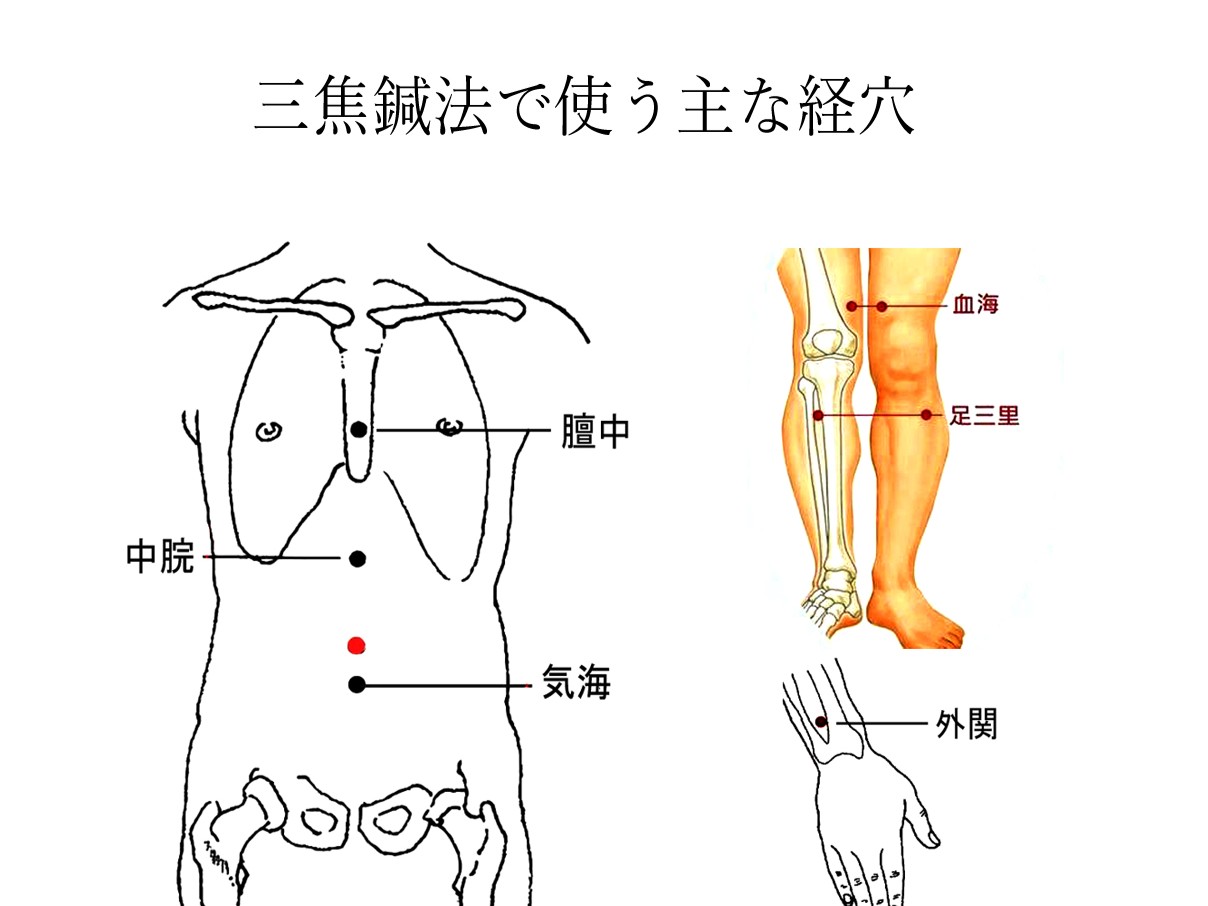 三焦鍼法のイメージ・鍼灸施術の様子